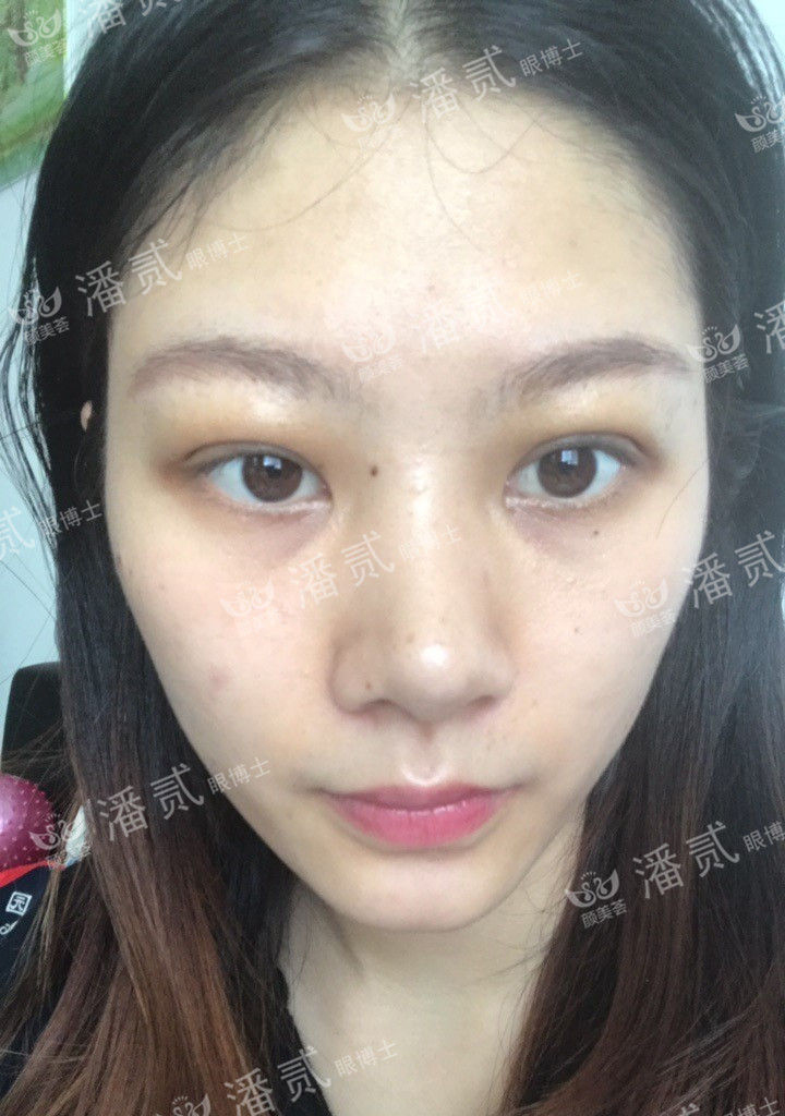 肿眼泡抽脂肪埋线双眼皮效果,肿眼泡割双眼皮长脂肪