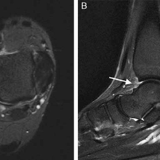 深蹲对脚踝韧带的改善,脚踝灵活性提高