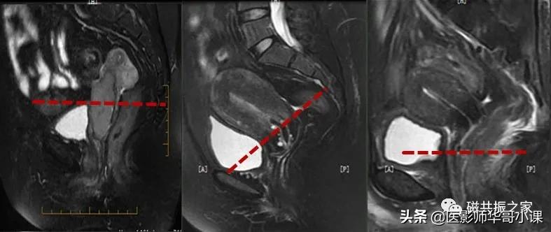 「精品课件」带大家看看,磁共振子宫MRI要如何扫描?