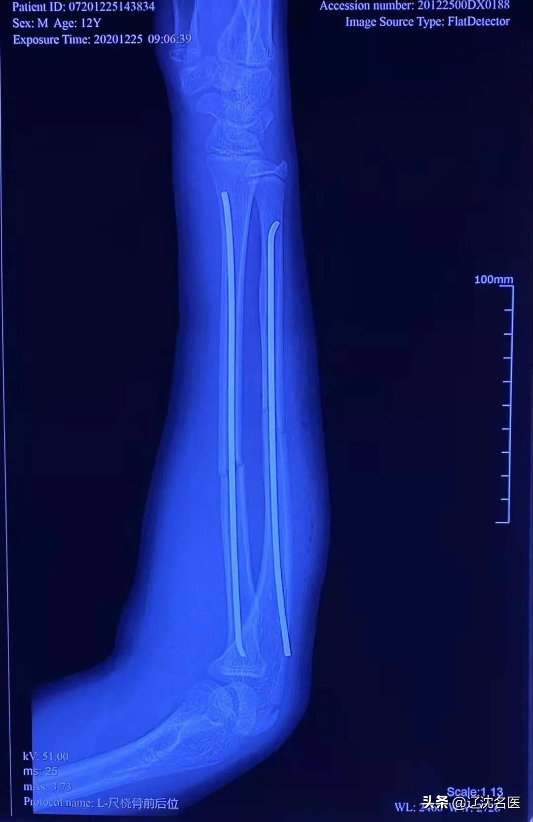 儿童尺桡骨双骨折保守治疗后错位,六岁儿童桡骨颈骨骨折多久恢复
