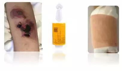 输液时肌腱损伤怎么办,输液造成组织坏死