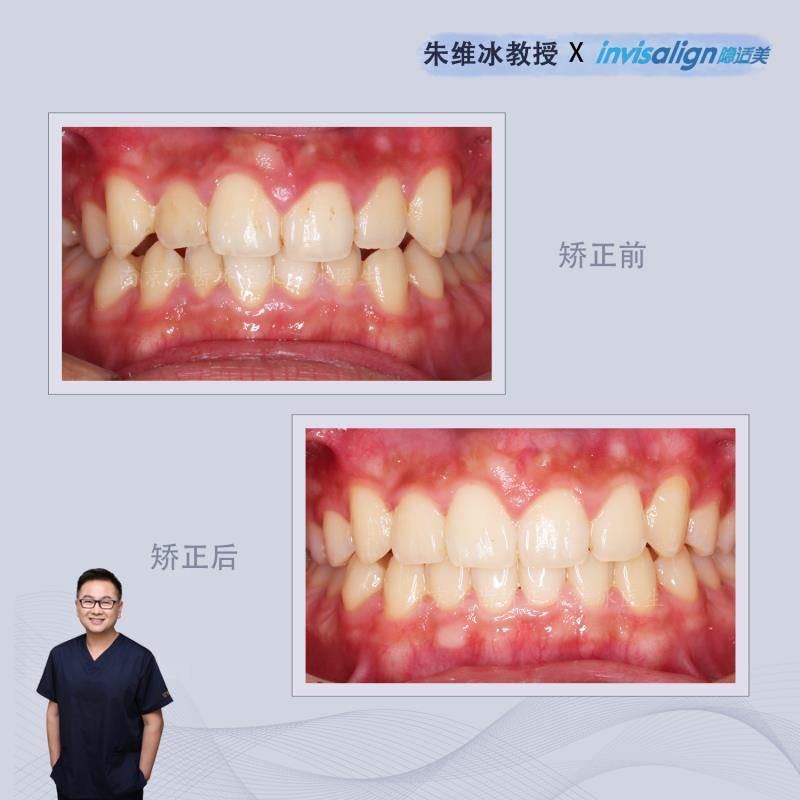 隐适美牙齿拥挤矫正真实案例,南京朱维冰