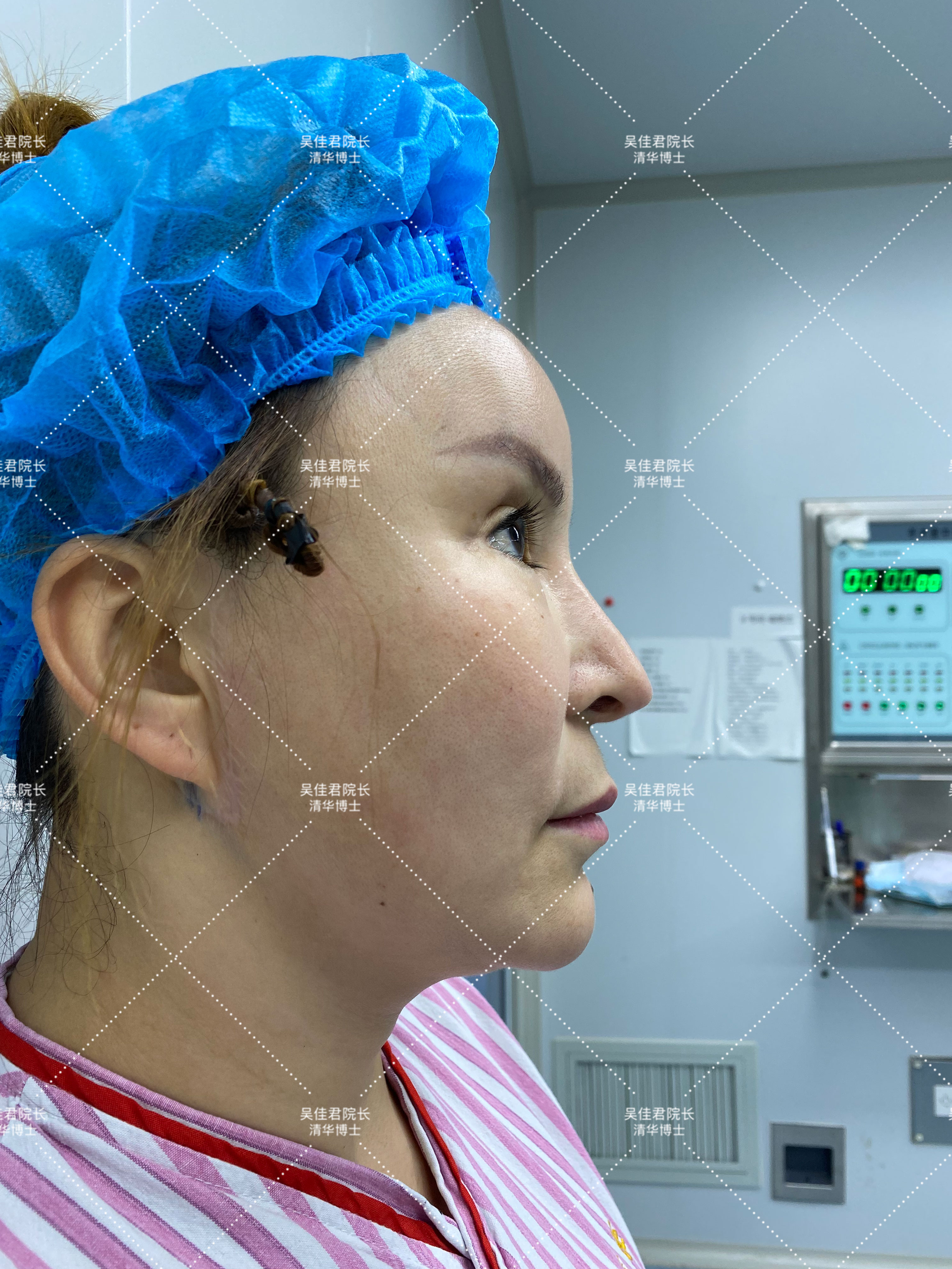 做小拉皮术后怎么保养,做拉皮手术的亲身经历注意事项