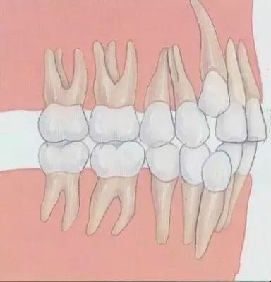 牙齿矫正有4个误区,牙齿矫正的副作用知多少
