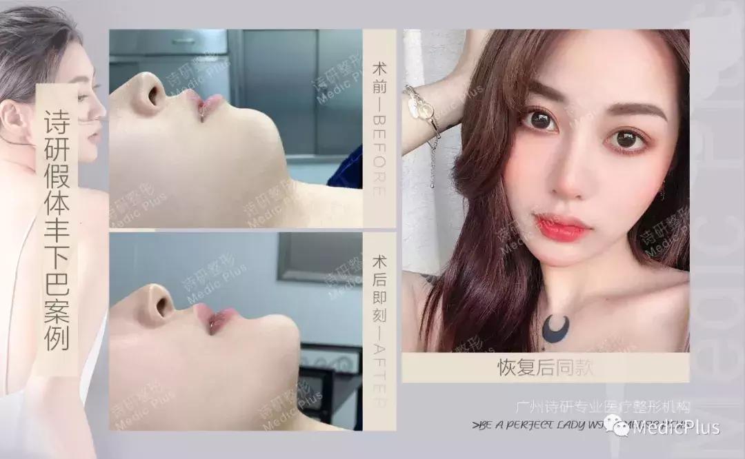 丰下巴可以改善下巴后缩么,丰下巴手术前后对比照片
