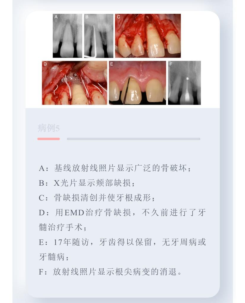 牙周病引起的牙髓病变的治疗原则,牙周组织可以修复再生吗