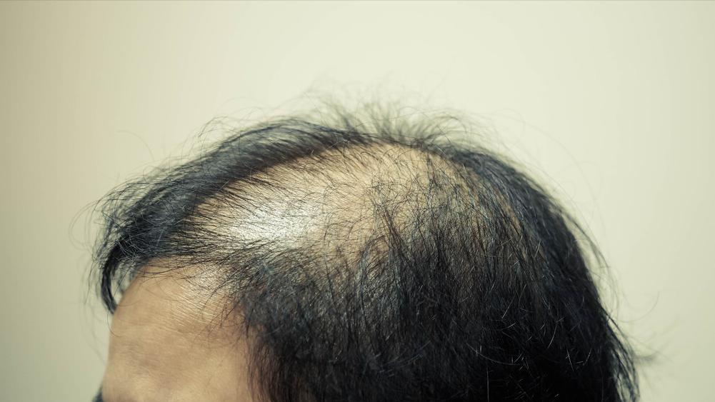 脱发严重试试这个方法防脱发,手把手教您防止大量脱发的方法