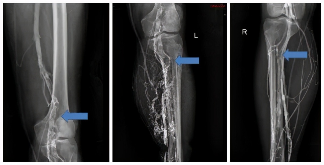 文登整骨医院治疗截瘫,山东文登整骨医院治疗怎么样