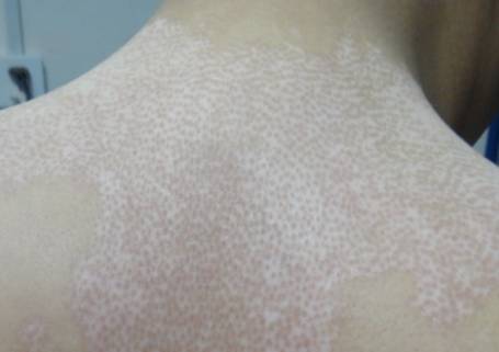 白癜风好转的迹象白斑的颜色,白癜风白斑变明显了