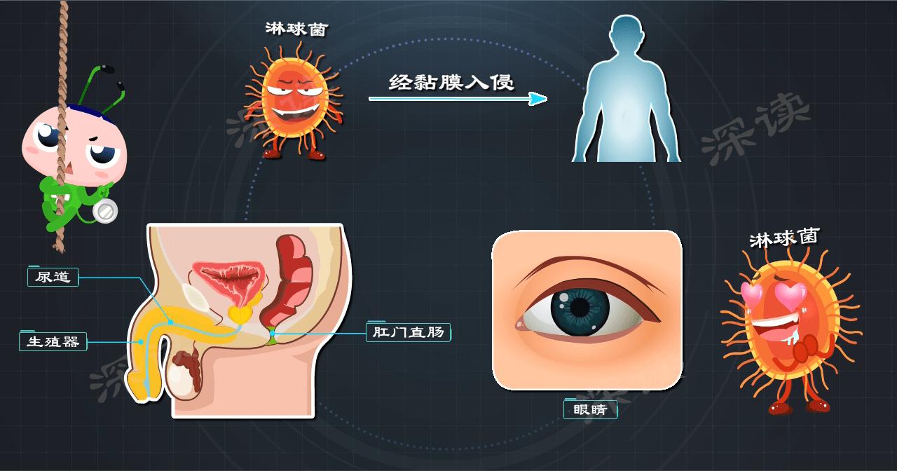 女性如何知晓得了淋病,女的有淋病一次就能中招吗