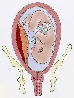 二胎妈妈频繁宫缩,命悬一线却浑然不知