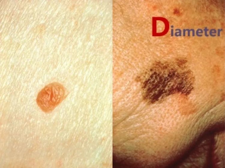 黑色素痣癌变的前兆切除能治愈吗,激光点黑色素痣能诱发恶变吗