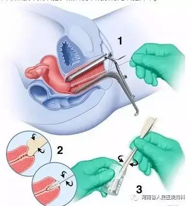 你知道什么是宫颈糜烂吗?