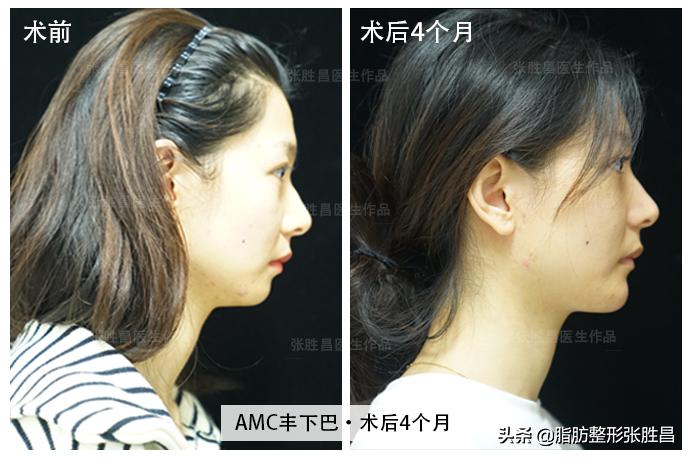 下巴缩短整容女,下巴短小北京