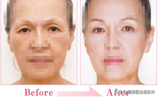 下眼皮松弛祛松皮后会回缩吗,上眼皮松弛下垂怎么办不用眼霜