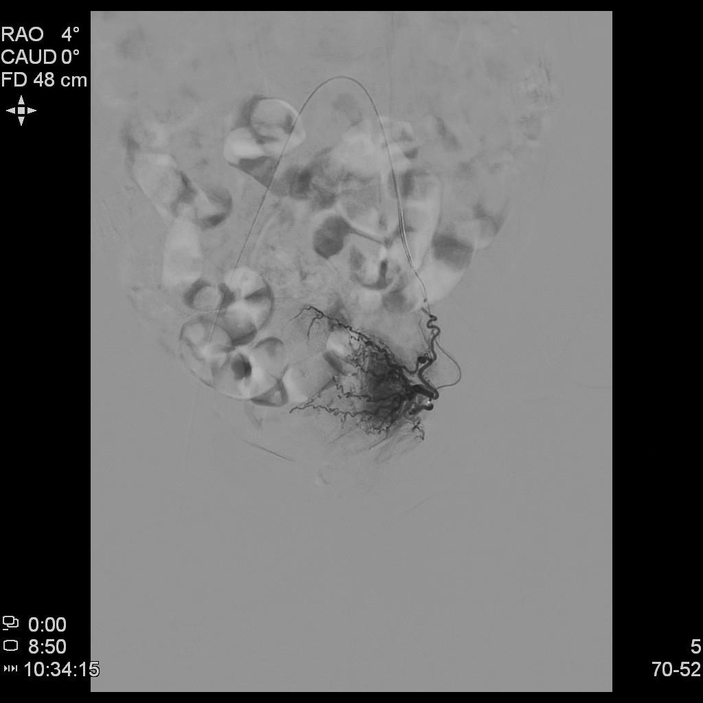 子宫腺肌症介入栓塞全国哪里好,子宫腺肌症介入栓塞治疗报销吗