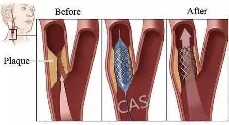 颈动脉斑块有哪些症状和危害,颈动脉有斑块能搓揉吗