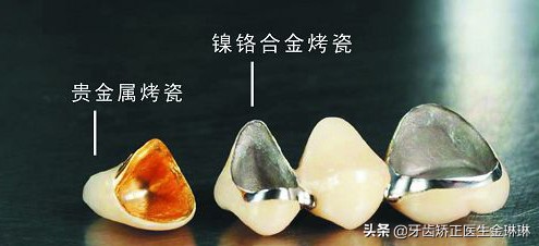 山东烤瓷牙修复,淄博烤瓷牙好不好