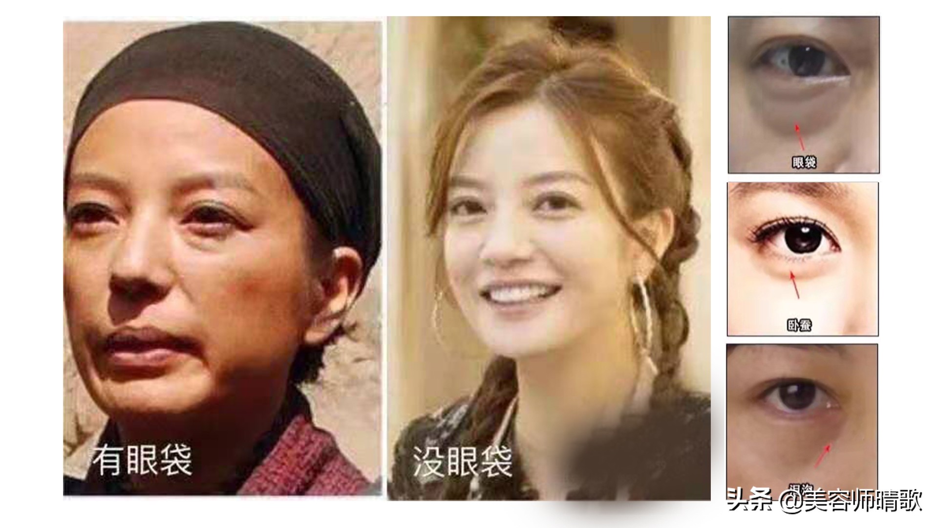 目前最有效的去眼袋方法,有啥好办法能去大眼袋