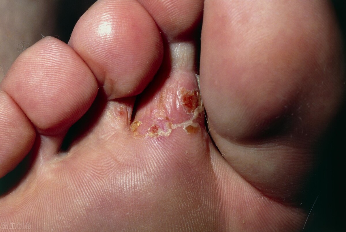 脚气足癣怎么治疗最有效,香港中医治疗脚气的偏方