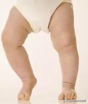 o型腿的自我鉴别及矫正方法,怎么知道o型腿是不是在慢慢变好