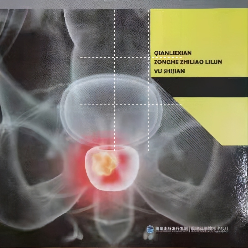 前列腺癌的精准诊断与治疗书籍,有关前列腺癌治疗的综述