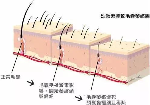 脱发严重毛囊不生发了,脱发毛囊萎缩图