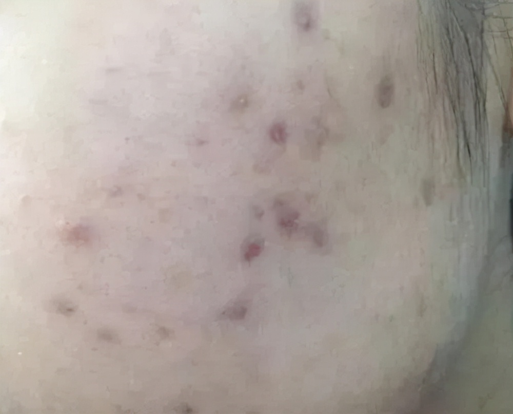 sor索尔祛痘去黑头价格,sor索尔祛痘怎么用