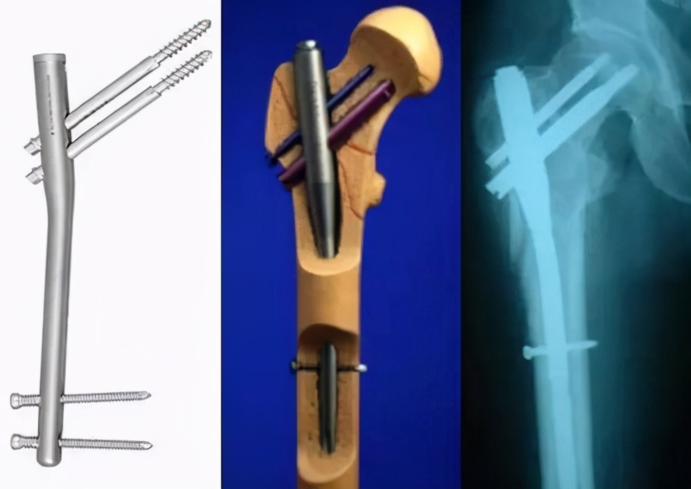 骨折上的钉还用取出来吗,骨折放的钢板是铁的吗