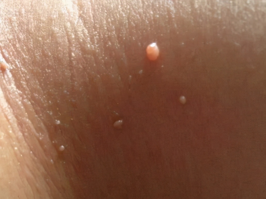 脖子腋下腹股沟长小肉粒怎么去除,腋下脖子上长小肉粒是什么原因