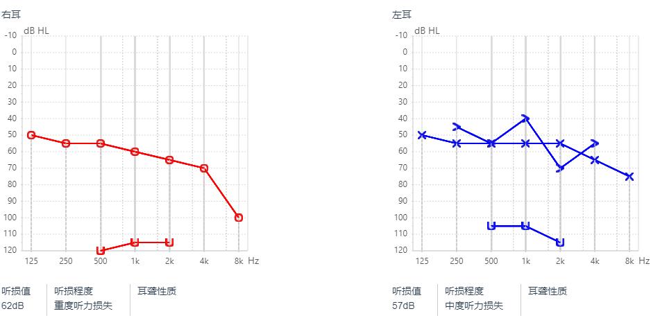 三高影响听力吗,三高引起的耳聋怎么办
