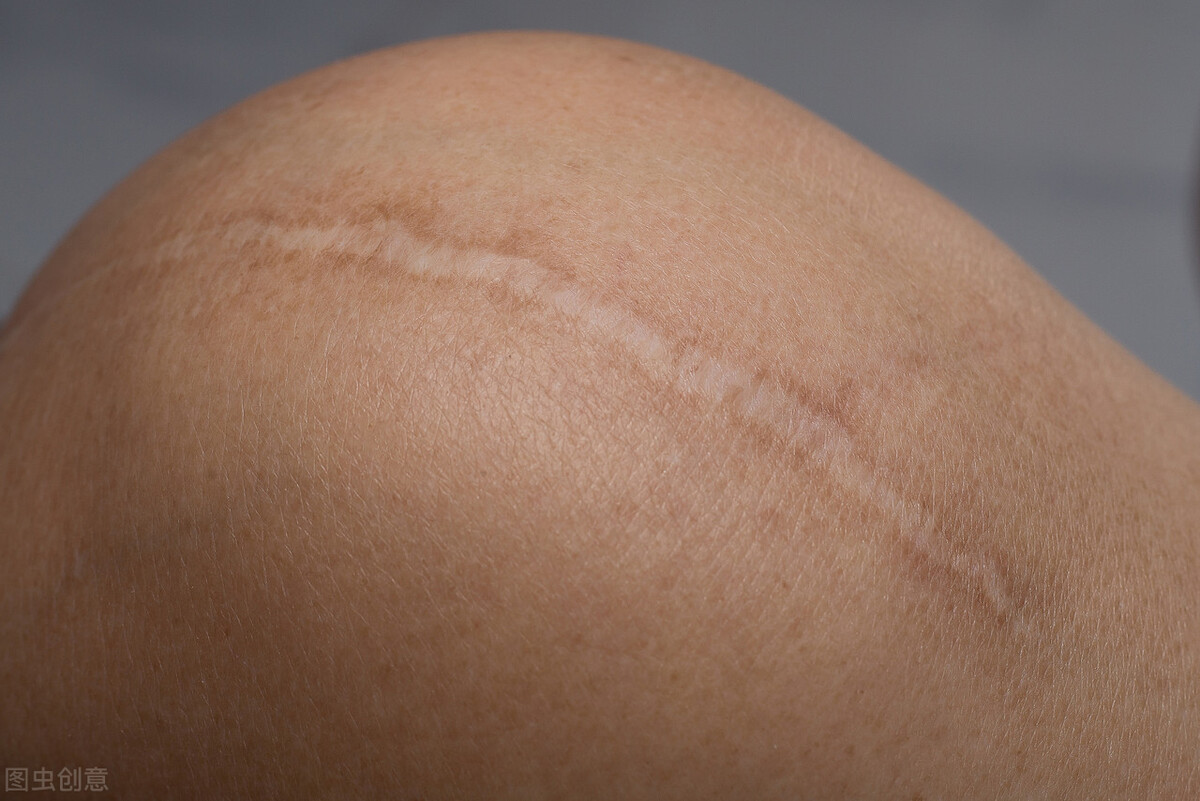 如何有效去除新疤痕,祛除疤痕的药可以祛除痘印吗