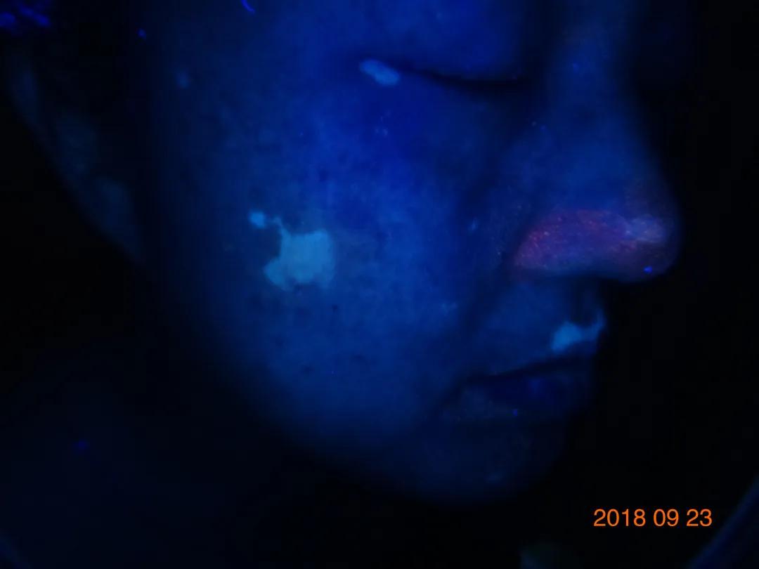 白癜风治愈一百例,白癜风治愈患者分享痊愈经验