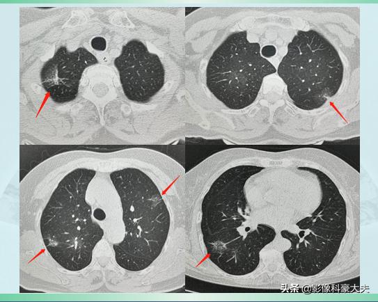 肺癌基因突变会遗传后代,基因突变的肺癌遗传吗
