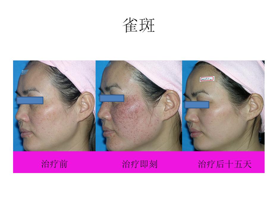 超皮秒华美,超皮秒专场直播