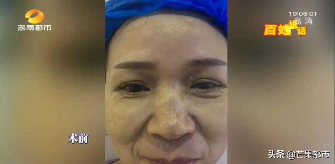 医生推荐去除法令纹,长沙哪个医院可以打法令纹