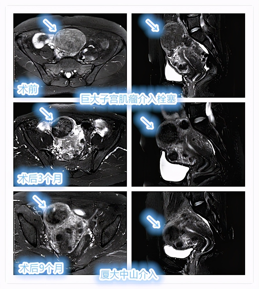 子宫肌瘤介入栓塞对子宫影响,子宫肌瘤介入栓塞的副作用