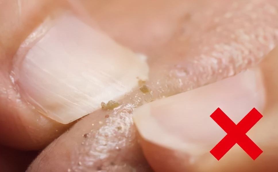 闭口粉刺如何正确护肤,闭口粉刺肌肤怎么护理