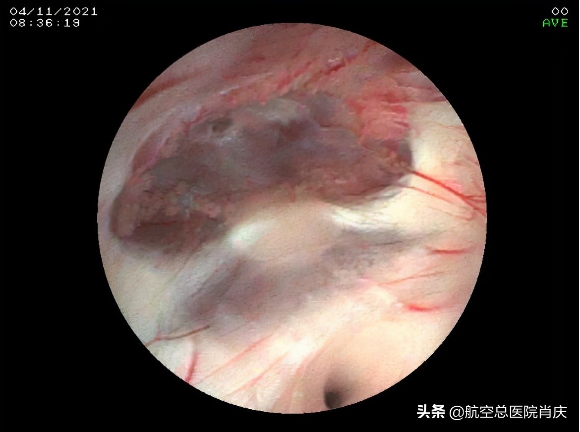 鞍上池蛛网膜囊肿手术费用,鞍上池蛛网膜囊肿影响智力吗