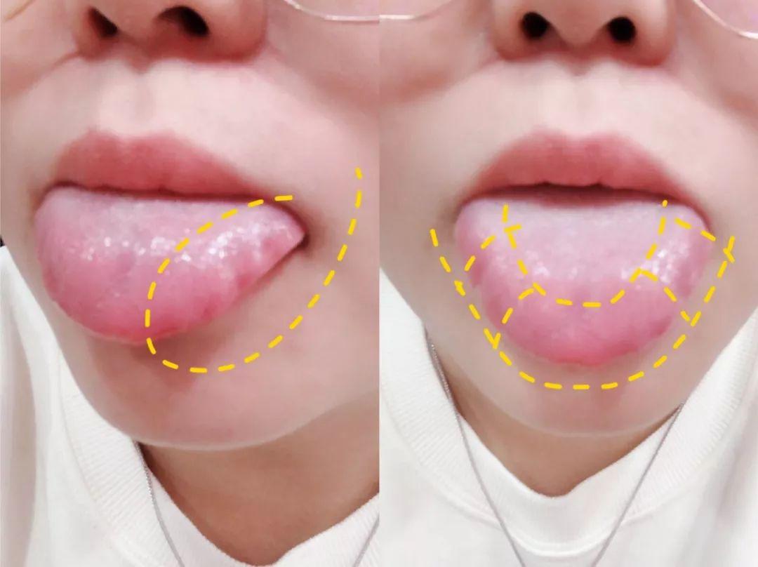 舌下神经受损症状图片,舌下神经损伤后的表现怎么治疗
