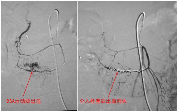 便血尿血怎么办,便血就医