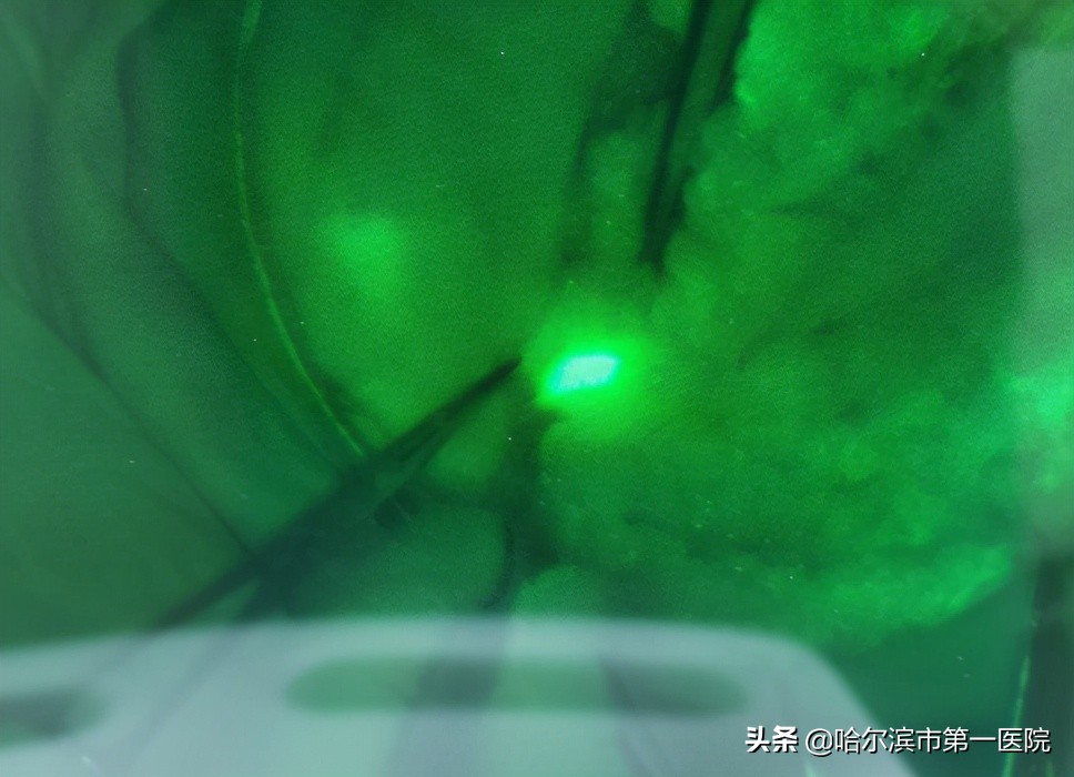 乳腺癌前哨淋巴结活检辅助手术,哈尔滨肿瘤医院做乳腺手术