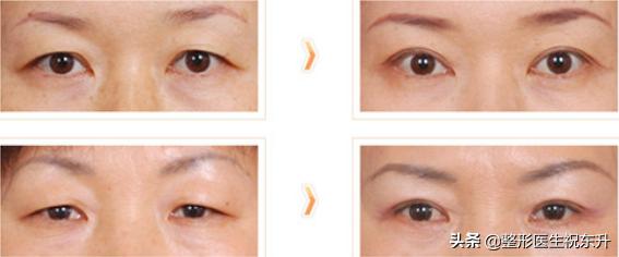 下眼皮松弛祛松皮后会回缩吗,上眼皮松弛下垂怎么办不用眼霜