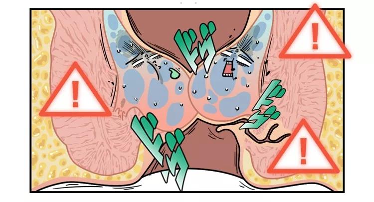 长痔疮怎么办最快的止痔方法,有痔青年怎么治