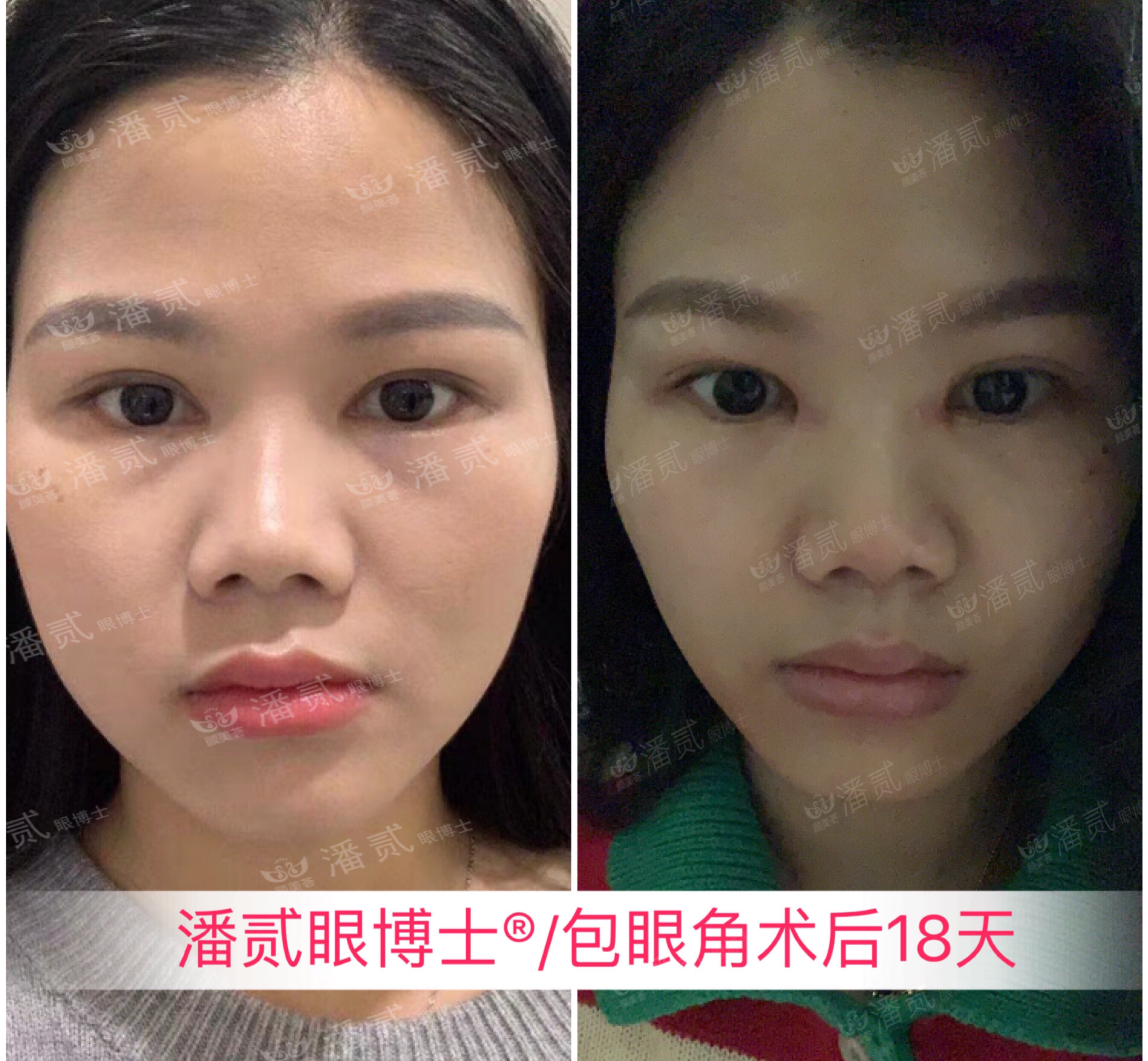 开内眼角会留疤的照片,开内眼角的疤痕变白色了怎么办