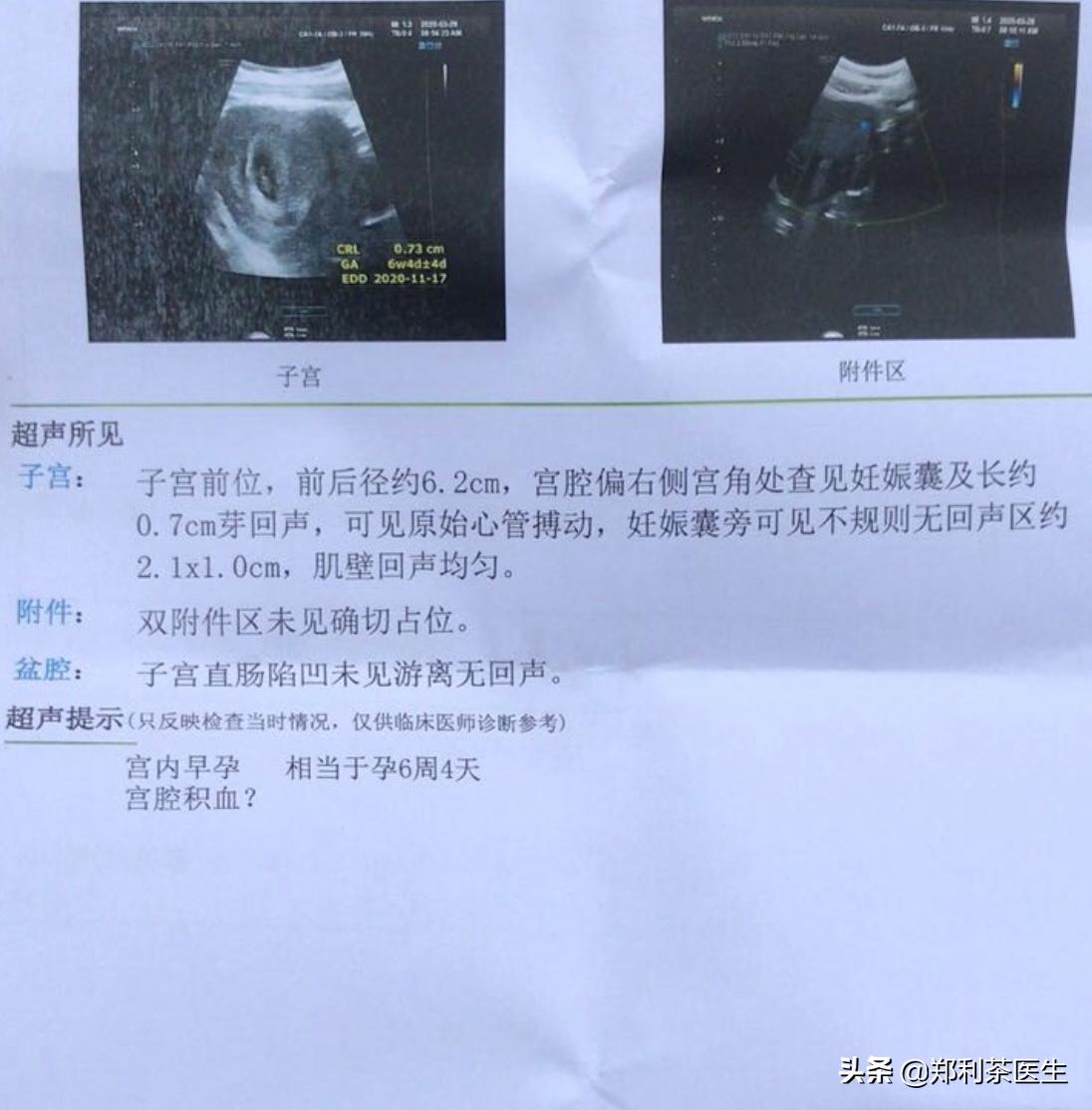 连续宫角妊娠,异位妊娠