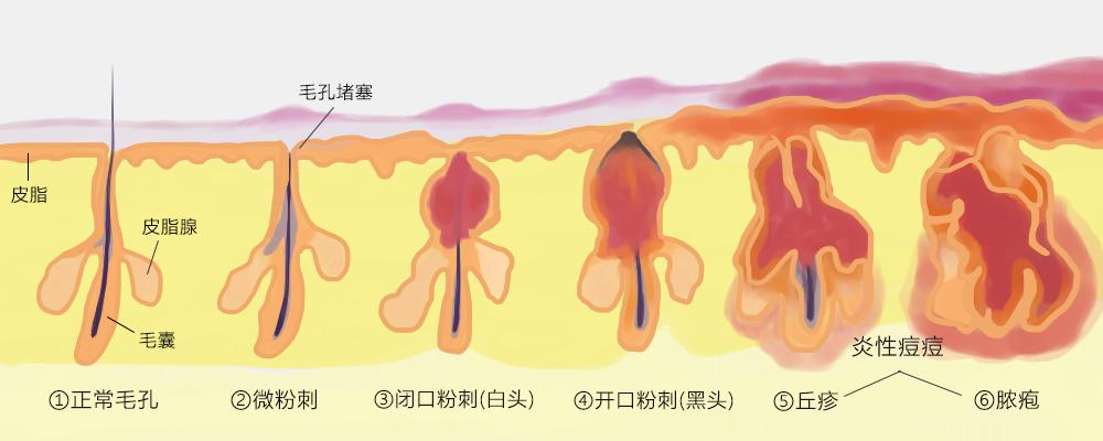 闭口粉刺如何正确护肤,闭口粉刺肌肤怎么护理