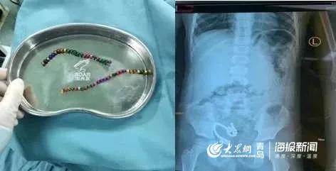 5岁男童误吞14颗瓷珠子,五岁男孩不小心误吞南酸枣粒
