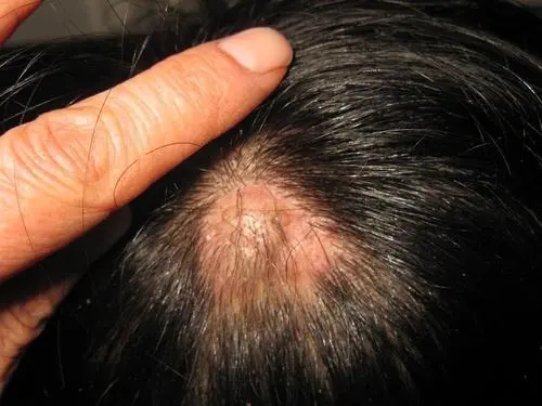 毛囊闭锁三联症怎么彻底治疗,毛囊闭锁三联征北京哪里可以治