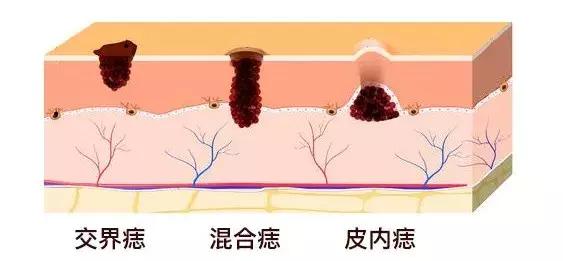 从小就有的肉痣30多年了会恶变吗,痣恶变的前兆是什么